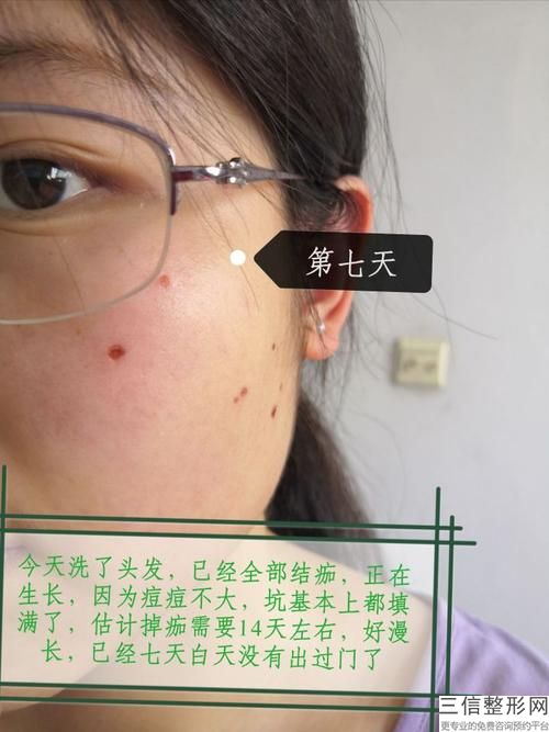 激光脱腋毛需要多少钱？及脱毛会痛吗？