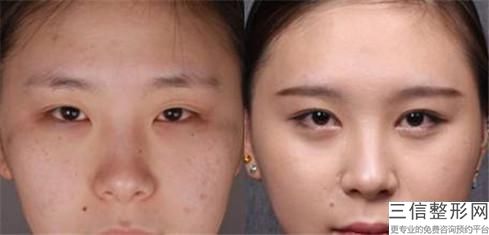 影响眼部修复手术费用的因素有哪些？吉林新华明