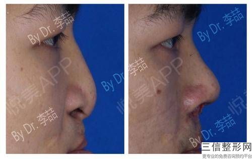 玻尿酸去除唇鼻沟效果好不好