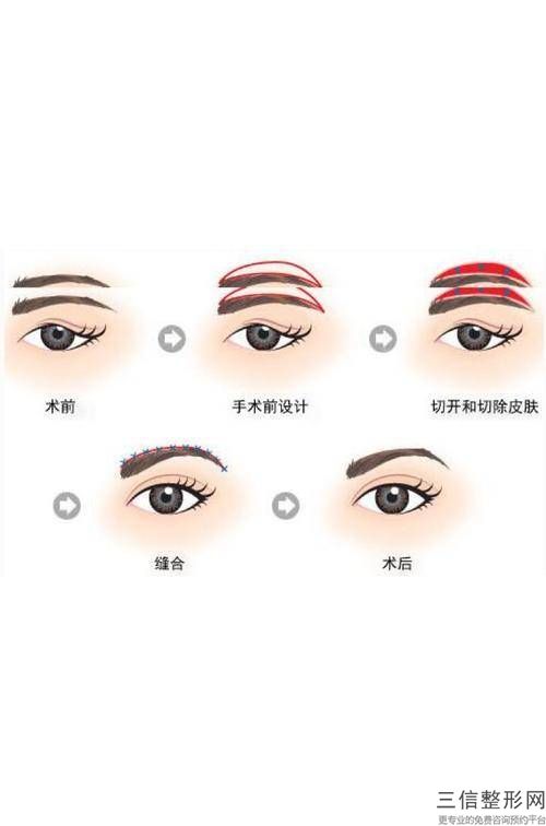 上眼睑去脂多少钱,上眼皮吸脂要多少钱