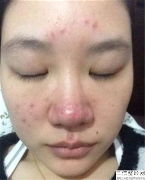 收缩鼻翼多少钱,收缩鼻翼要多少钱