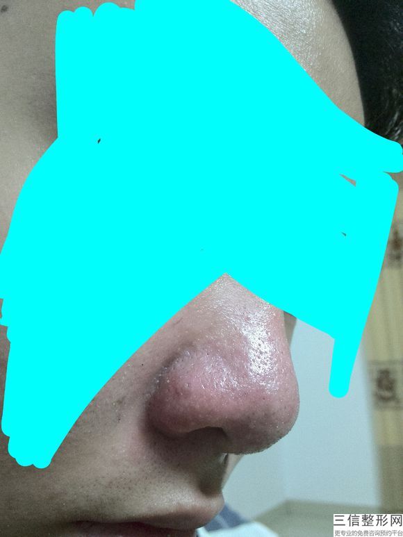 鼻孔里长痘(鼻孔里长痘痘是什么原因)