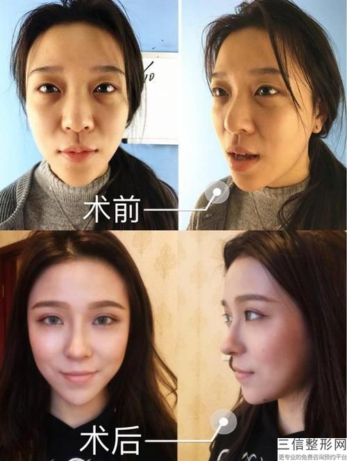 鼻梁不高怎么办(宝宝鼻梁不高怎么办)