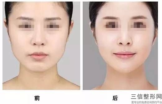 鼻梁骨过宽图片(鼻梁骨过宽图片突出)