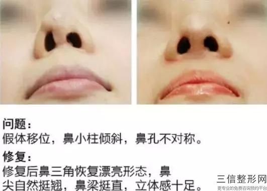 鼻部整形危险吗，请问鼻尖整形的方法有哪些