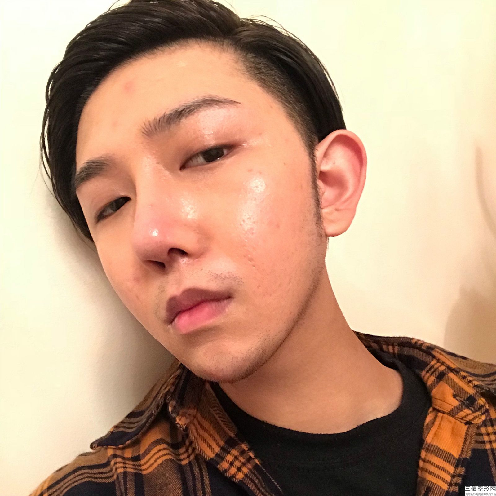 鼻尖整形用什么材料，鼻部整形术