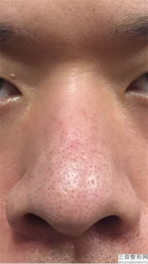 鼻尖整形用什么材料，鼻部整形术