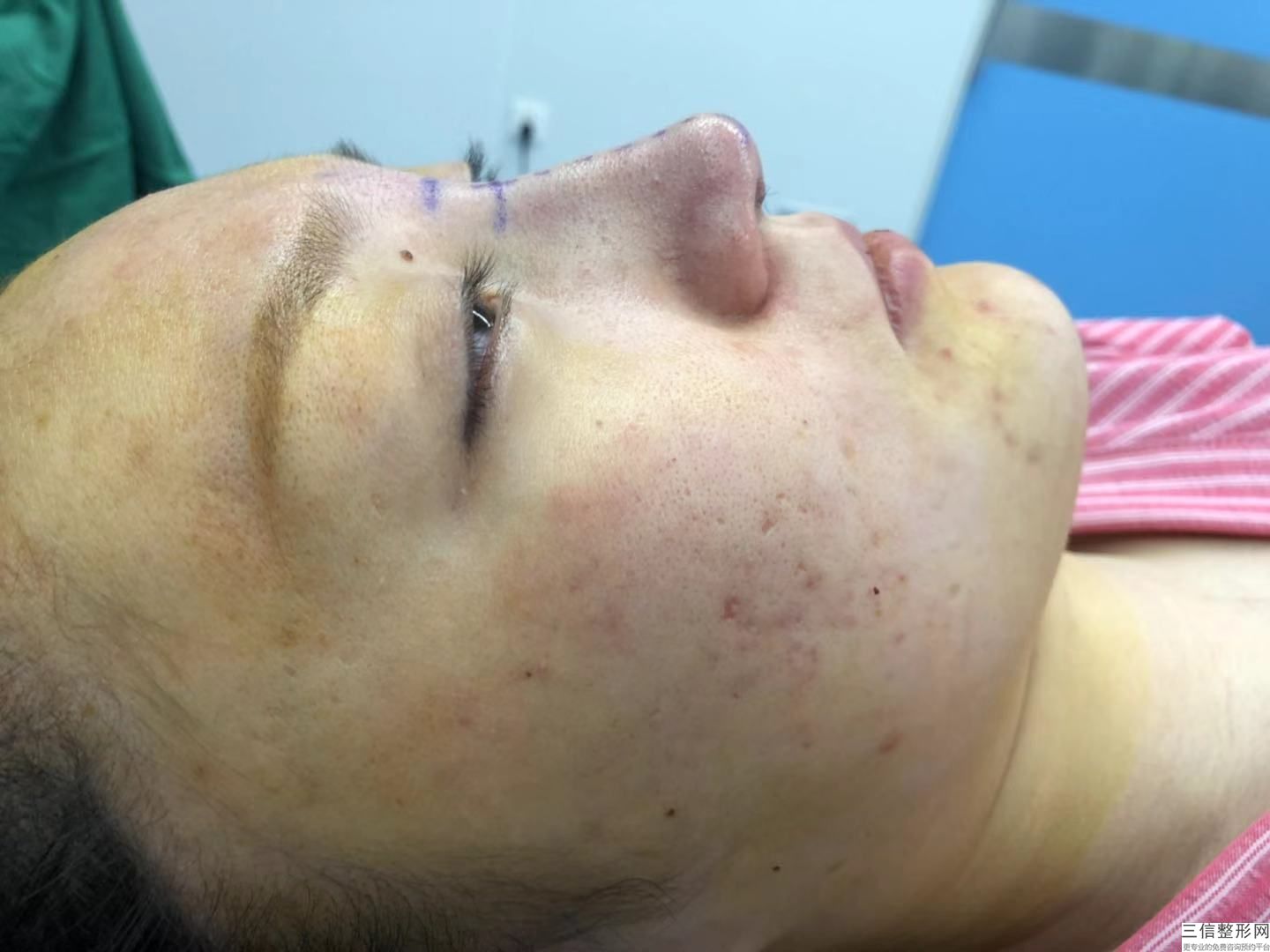 鼻梁过低怎么办，鼻梁偏低怎么办