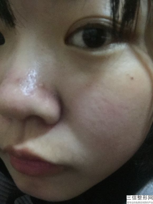 鼻子注射隆鼻，注射隆鼻有效吗
