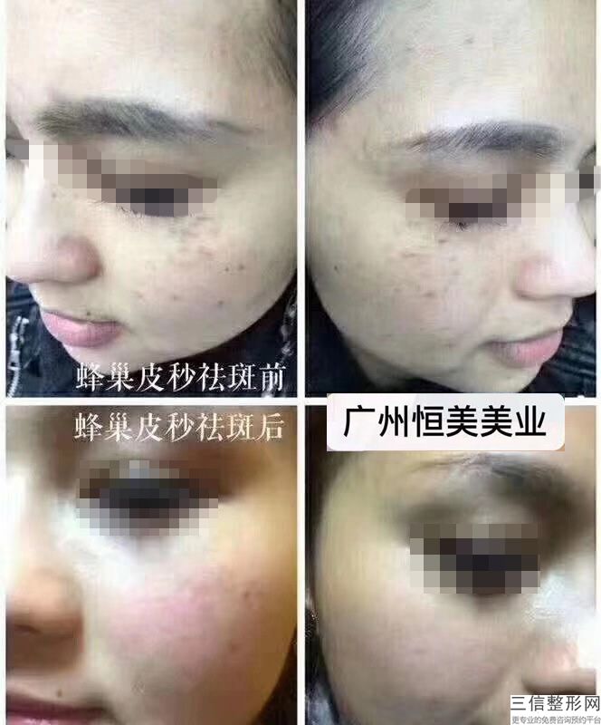 黄褐斑可以用激光去吗，激光祛黄褐斑后要注意什么