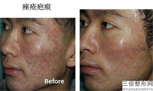 盐城市胶原蛋白注射法填充痤疮瘢痕医院排名前十位汇总在这里(盐城市胶原蛋白注射法填充痤疮瘢痕整形医院)