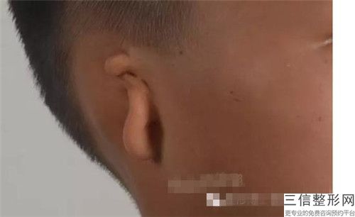 天津市先天性耳廓畸形医院人气榜前五网友推荐（天津市先天性耳廓畸形整形医院）