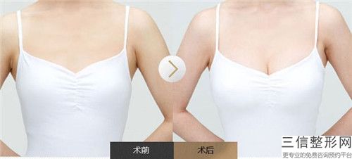 玉林市自体脂肪颗粒注射移植隆胸术医院排行榜前十强呈现（玉林市自体脂肪颗粒注射移植隆胸术整形医院）