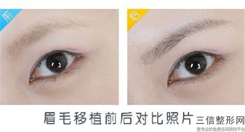 唐山市硅胶垫眉弓医院排行榜前十佳较新榜单发布（唐山依莱美艺术整形门诊部10强专家推荐）