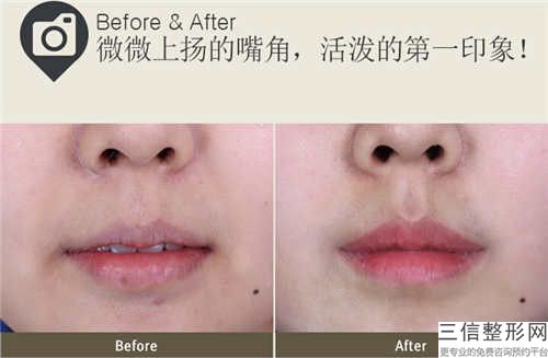 陕西省成人唇裂医院口碑排行前十良心推荐（陕西省成人唇裂整形医院）