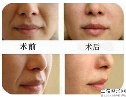 曲靖市自体血小板除皱医院口碑排名十强口碑盘点(曲靖市自体血小板除皱整形医院)