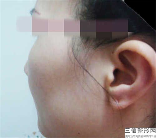 邯郸市脸部磨骨新版价格表2023优惠全览-邯郸市脸部磨骨价格需要多少钱