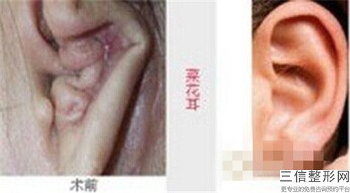 佳木斯市整容耳朵价格表优惠在线预览-均价整容耳朵27068元