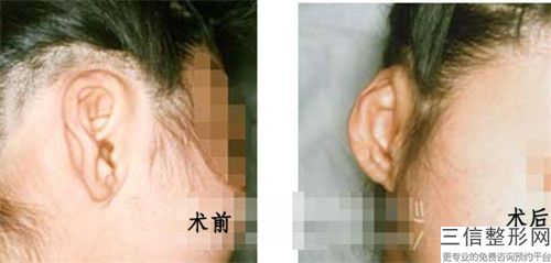 北京耳朵整容得整形手术价格_北京耳朵整容得一次要花多少价格呢
