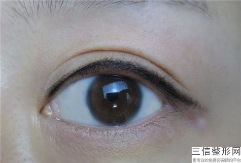 徐州京城医美中心超声法眼袋手术大致有哪些危害
