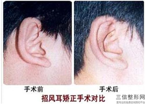 人的耳畸形可能出现哪些副作用吗