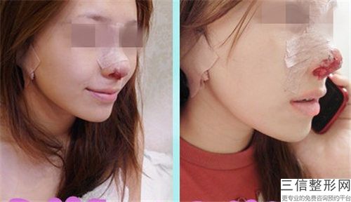 宿州天使医疗美容门诊鼻翼吸脂手术费用不一样是为什么