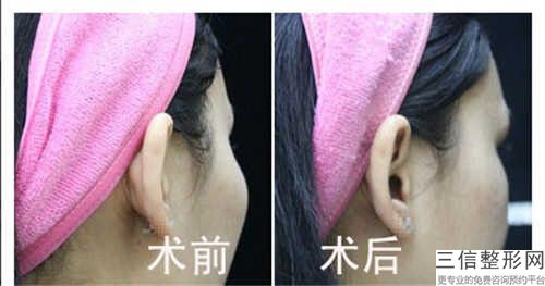 德清蝶来美容院价目表公开&均价一览-胫骨外翻截骨案例