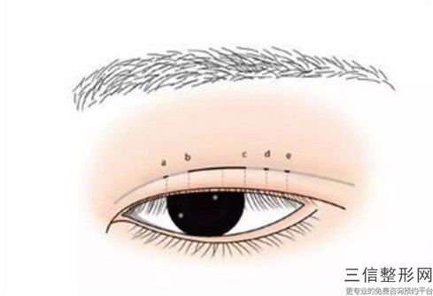 阜阳消除黑眼圈手术的价格影响因素
