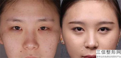 咸阳无痕双眼皮修复美容有没有不良反应