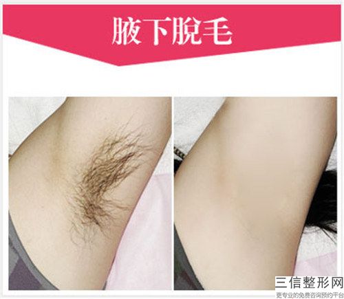 芜湖市男秃头植发价格价位表全新版本(男秃头植发均价为：6458元)