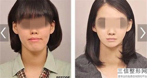 柳州整形兔唇手术拆线后怎样护理