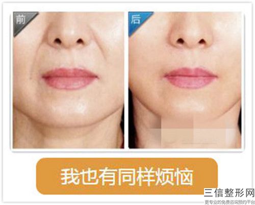 激光去妊娠纹手术手术是否有风险吗