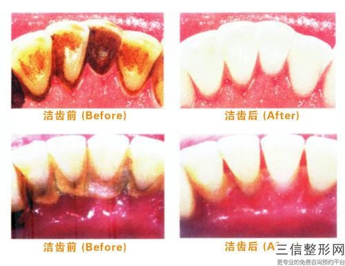 西城区看牙种植钉医院哪家好（首都医科大学附属复兴医院口腔科口碑价格整理发布~）