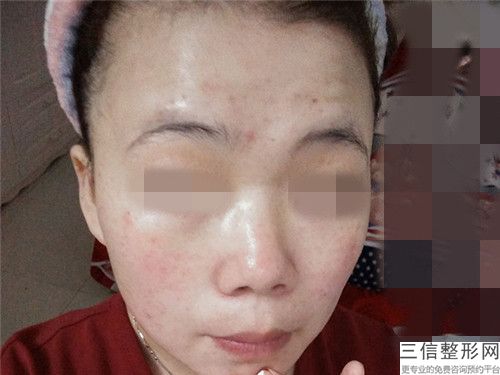 激光去太田痣斑会不会对皮肤有副作用呢
