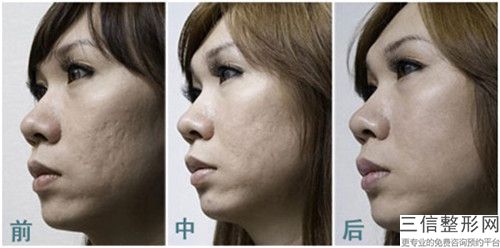 中国可以做瘢痕疙瘩的医院：瘢痕疙瘩医院前50技术对比
