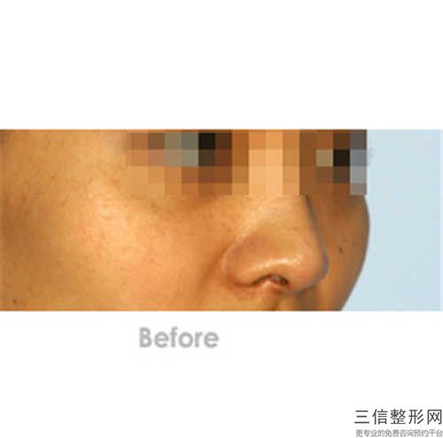 清远打磨颧骨手术的效果受什么因素影响