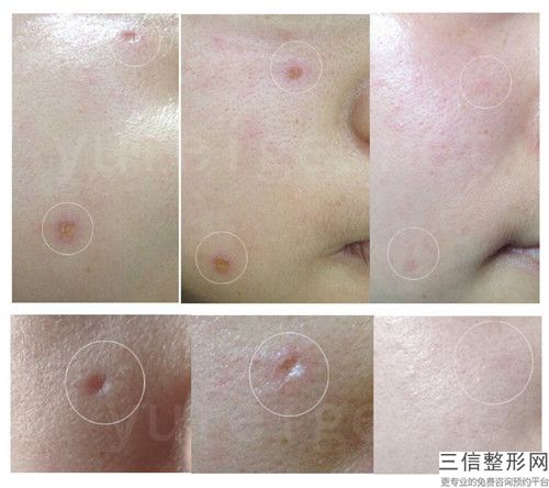 常州市激光完全消除疤痕哪里整形医院好-溧阳圣蓝医院一起来瞧瞧实力高低~