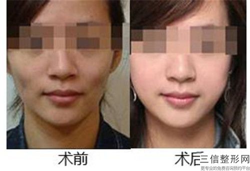 山西省面部拉皮除皱手术医院推荐：面部拉皮除皱手术医院综合实力前30佳名单请查收
