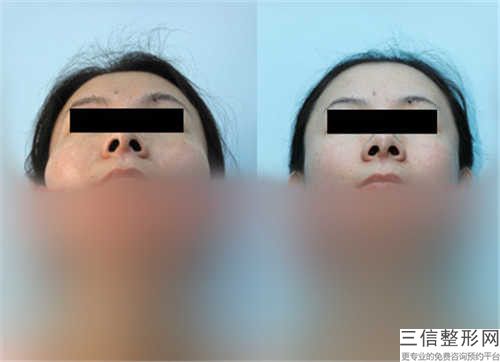 泰州市颧弓下颌骨手术医院排行榜前十佳口碑高的医美（泰州秀玲微整美容口碑好收费不坑）