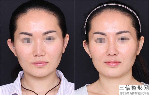 王培整形医生鼻骨切除手术都值得选-郑州至美医疗美容门诊部