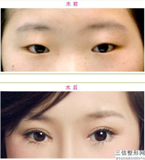 深圳爱尔眼科医院皮秒激光光子嫩肤手术几天可以出效果