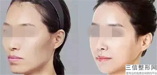 台州市非常好人民医院医疗美容科瘦脸吸脂效果怎么样