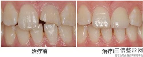 张常牙齿补充原理和术后护理
