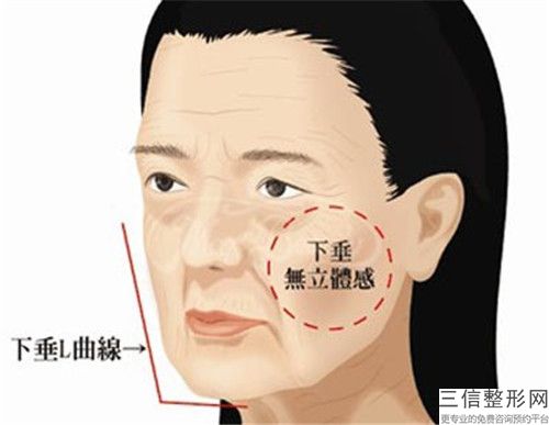 田波面部注射填充取出术可以保持几年