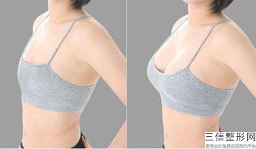 濮阳李兴均外科诊所副乳手术疤痕整形手术适合3类人群