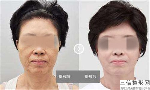 濮阳整形美容外科医院脂肪移植去抬头纹术的适宜人群与禁忌人群