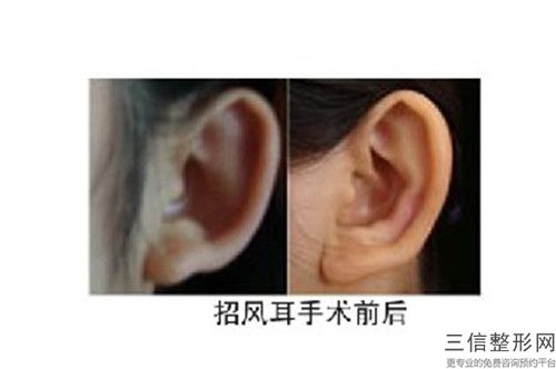 江苏<span data-mask=j-m-y-y>苏北人民医院烧伤美容整<span>形科收费标准新版参考-耳朵再造整形案例
