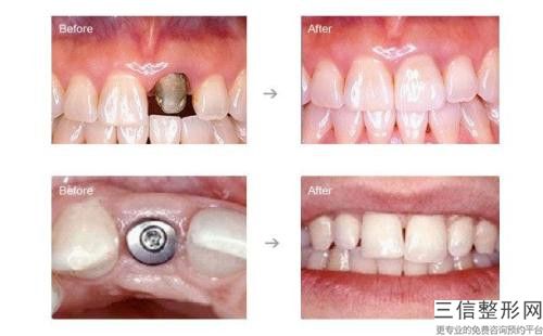 东莞东城街道smiledirectclub牙套矫正多少钱-2025年东莞东城街道smiledirectclub牙套矫正收费标准2026抢鲜价来了
