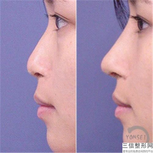河南省魏<span data-mask=j-m-y-s>培翰<span>医生,陈<span data-mask=j-m-y-s>旻静<span>医生鼻骨修正手术2026实力PK