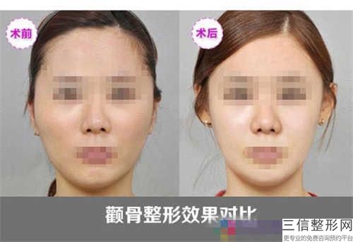 洛阳市下颌骨吸脂价目表全方位公开(下颌骨吸脂均价为：18301元)